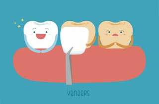 Porcelain veneers Porcelain veneers