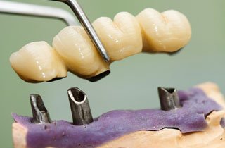 dental bridge types