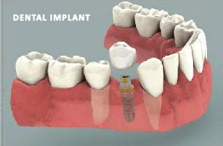 dental bridge or implant