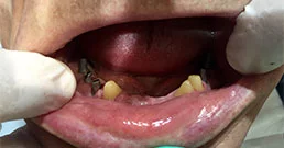 dental-implants-reviews