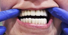 tooth implant reviews