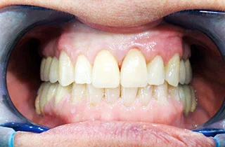 no prep veneers