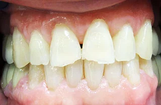 non prep veneers