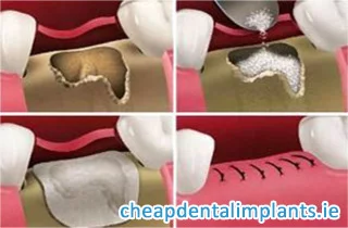 dental bone graft 