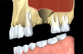 dental bone loss