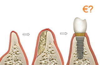 Dental bone graft cost