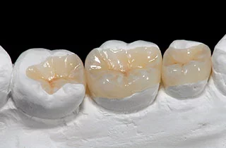  Dental inlay 