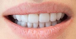 Cosmetic dentistry before and after cosmetic dentistry before and after