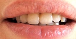 dental crown before and after