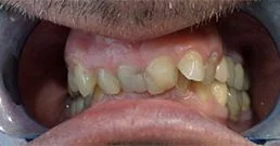 dental crown reviews