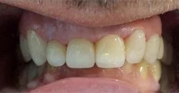 dental crowns before after
