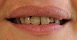 Dental crowns before and after Dental crowns before and after