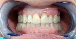 Veneers after veneers after