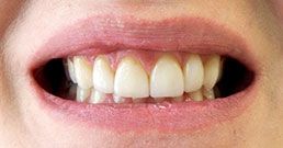 Hollywood smile before Hollywood smile before