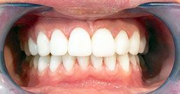 Hollywood teeth Hollywood teeth