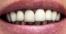 Smile makeover smile makeover