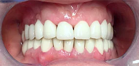 Teeth discoloration after treatment