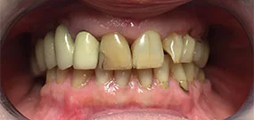 Teeth discoloration