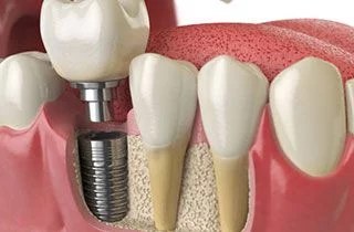 timeline of tooth implantation