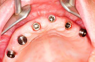 tooth-implant-procedure