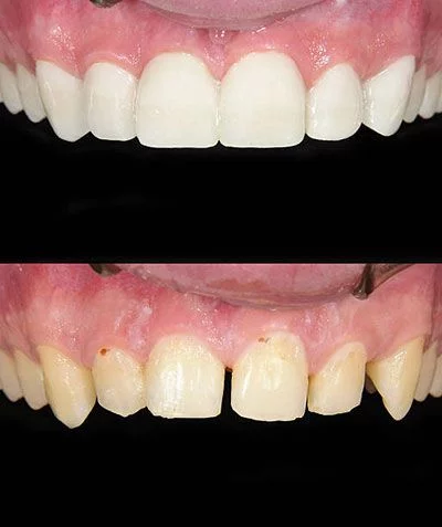 discoloured teeth