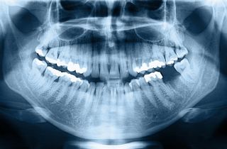dental bone loss